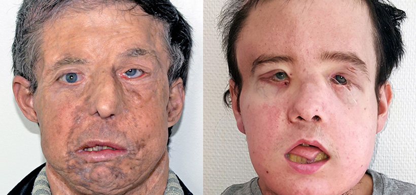 trasplante-rostro